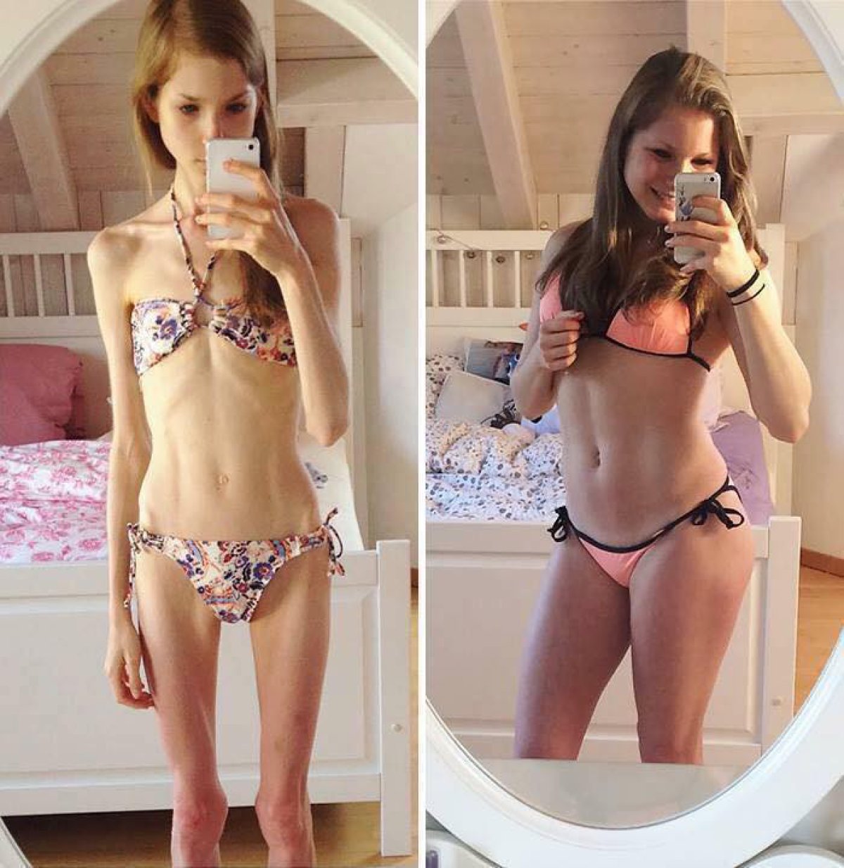 anorexia-recuperaci-n-el-antes-y-despu-s-de-chicas-que-sufrieron