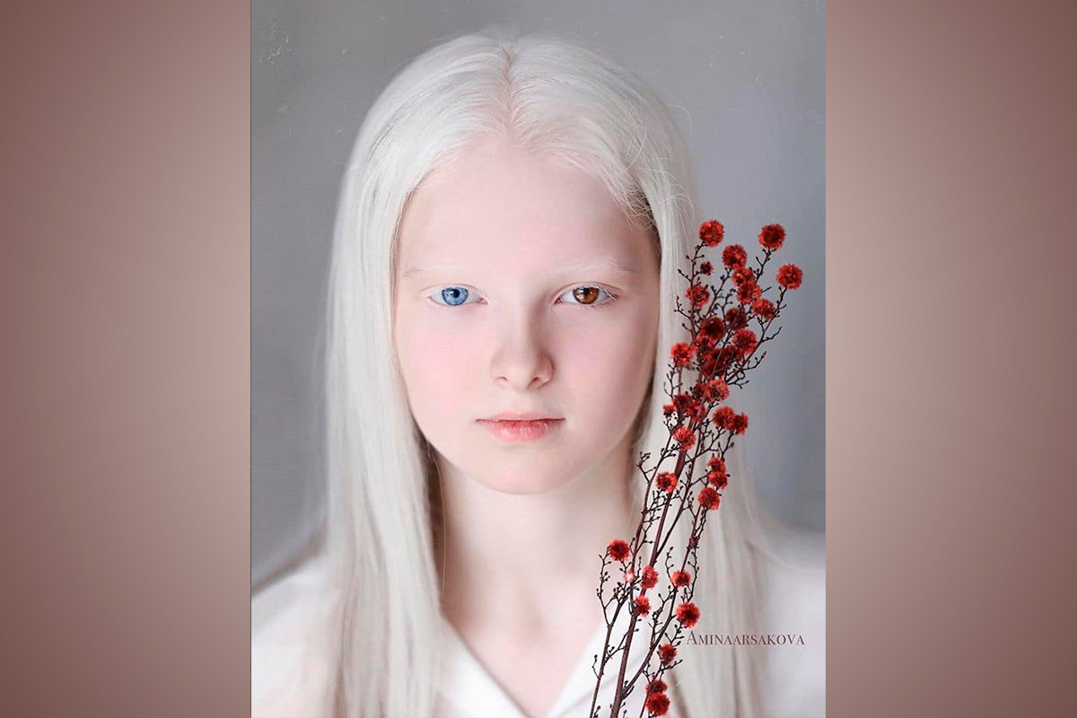 Albinismo Y Heterocrom A En Una Ni A Que Irradia Belleza Albinismo Y Heterocrom A En Una Ni A
