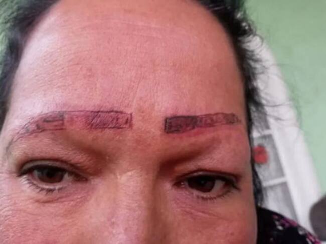 Dijeron que por su piel sensible la tinta la rechazó