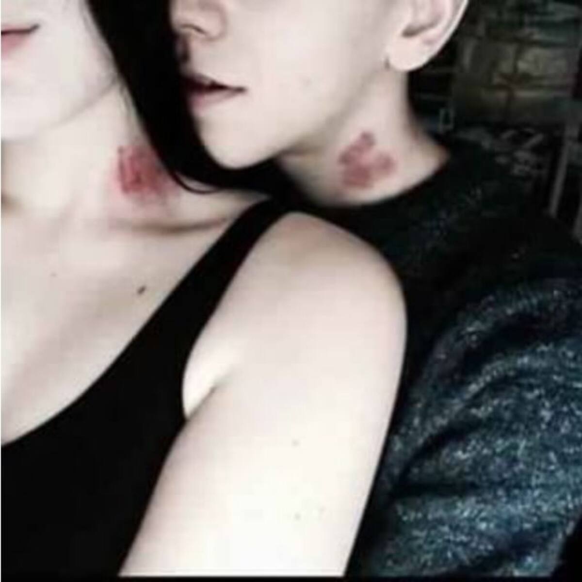 ¡Cuidado con los chupetones!