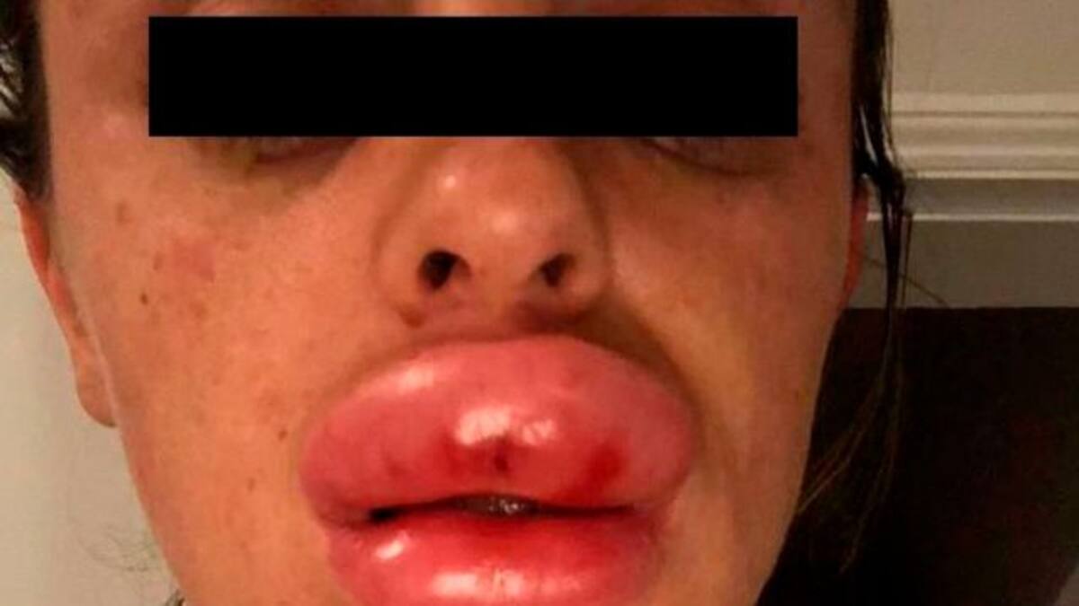 Fiesta de botox termina muy mal