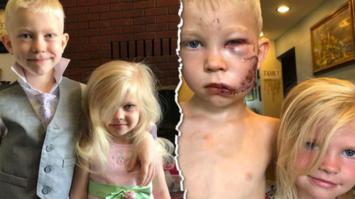 Niño defiende a su hermanita de un perro y recibe 90 puntadas