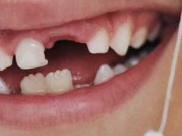 Padre recomienda a su hijo amarrar su diente a una ballesta y disparar