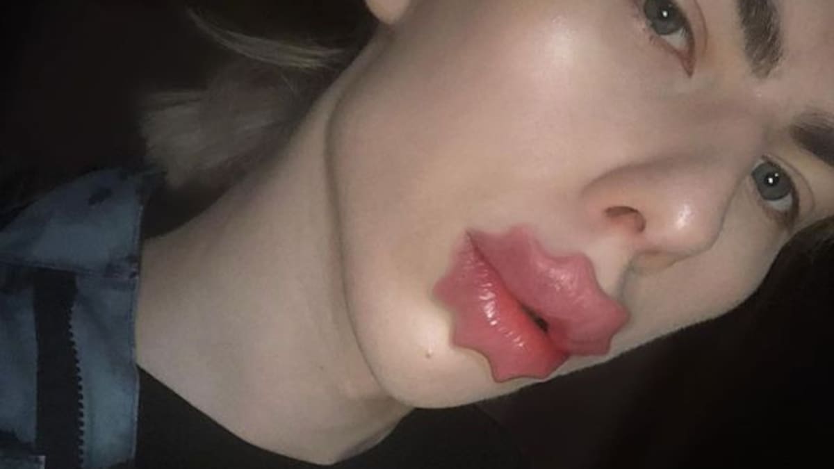 "Labios de pulpo" la tendencia que está causando terror