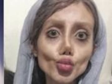 Así lucía la chica que se operó para parecerse a Angelina Jolie