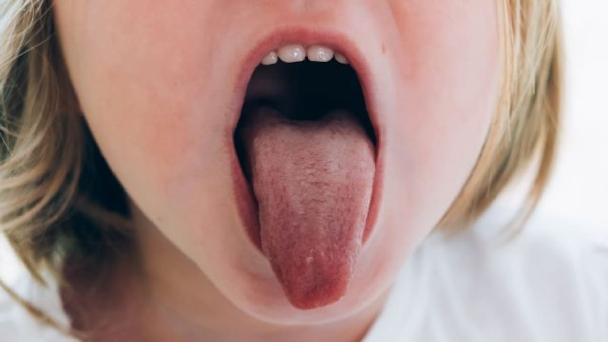 Kawasaki, la enfermedad en niños que se relaciona con el Coronavirus