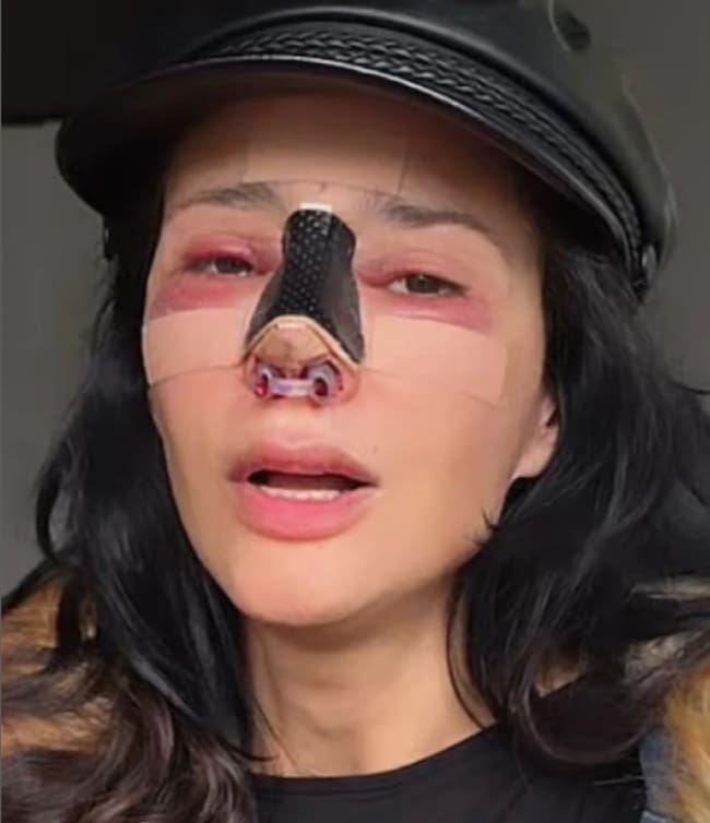 Dorismar reaparece luego de someterse a un nuevo procedimiento de reconstrucción de nariz