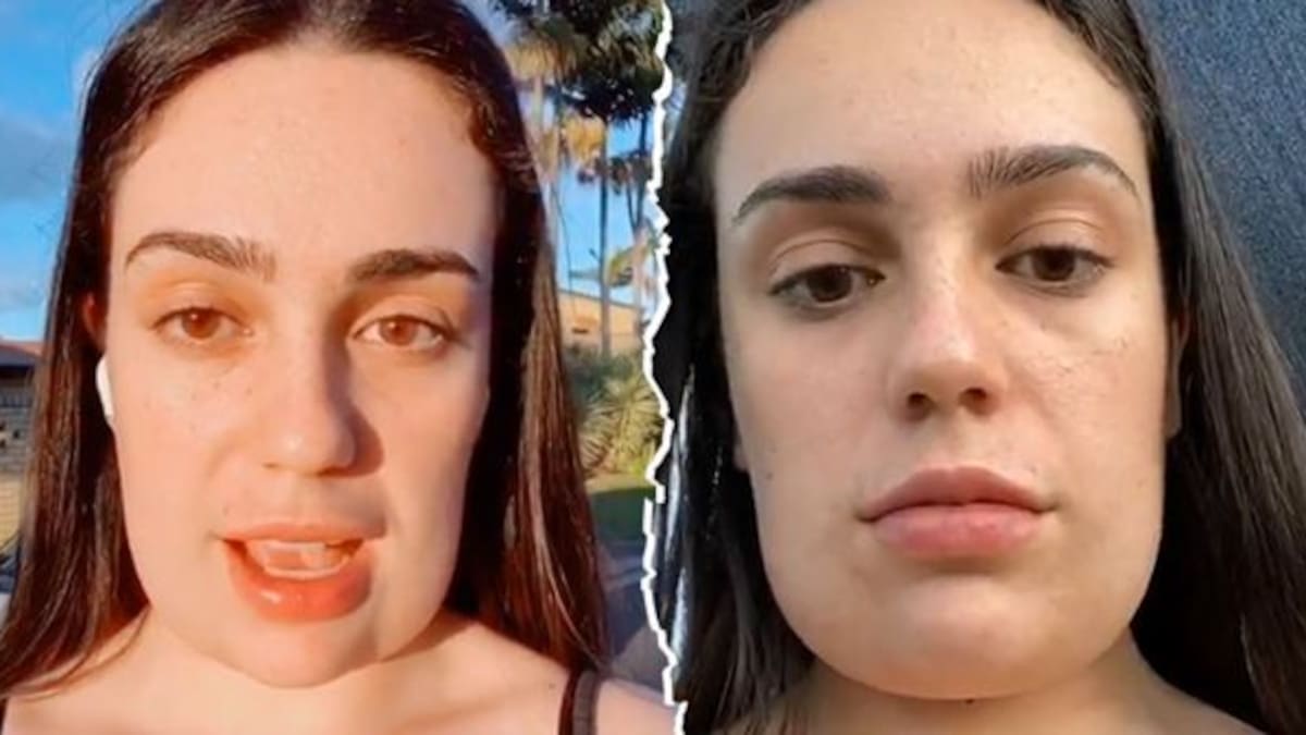 Se hace cirugía para quitarse la papada y le queda cuadrada