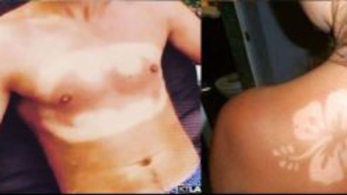 'Sunburn Art': tatuajes de quemaduras solares.