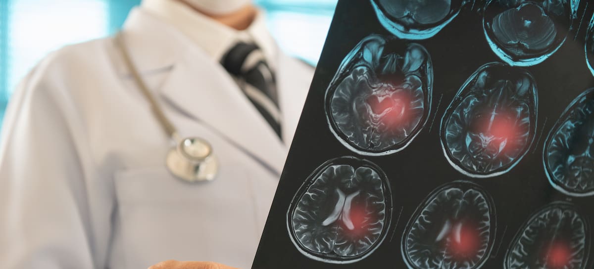 Estrella de televisión sufre derrame cerebral