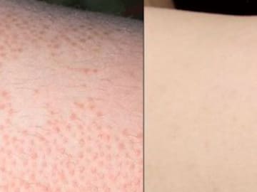 ¿PIERNAS DE FRESA? TE DECIMOS QUÉ SON Y CÓMO ELIMINARLAS