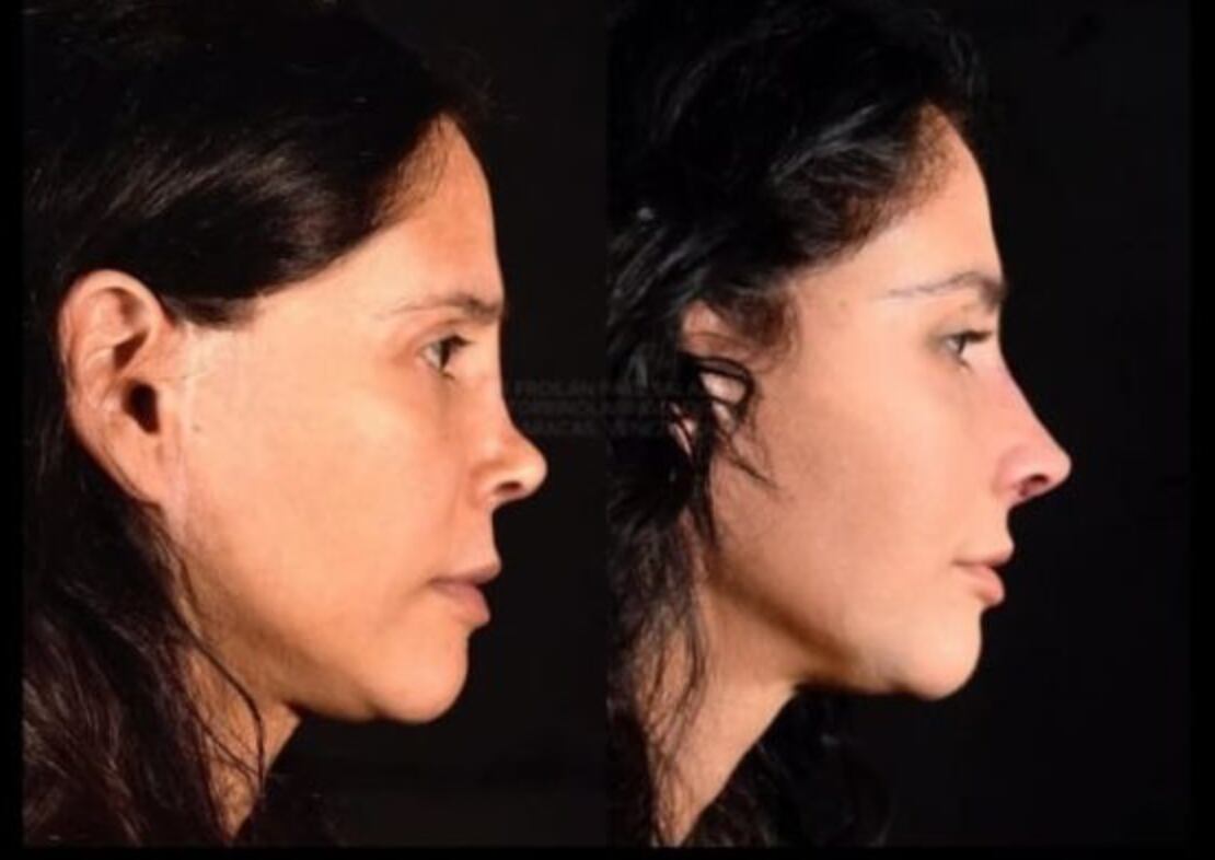 MX- Dorismar, recuperación de cirugía de nariz