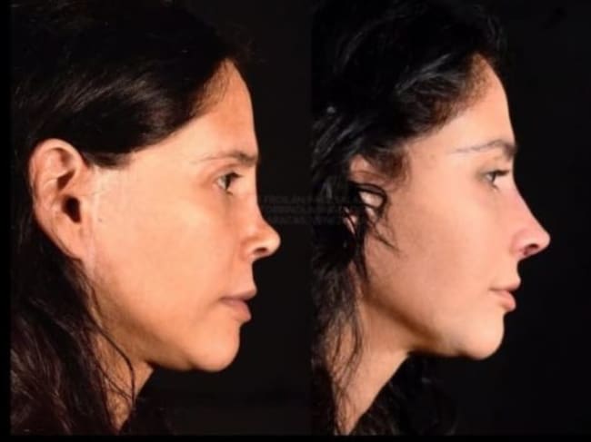 MX- Dorismar, recuperación de cirugía de nariz