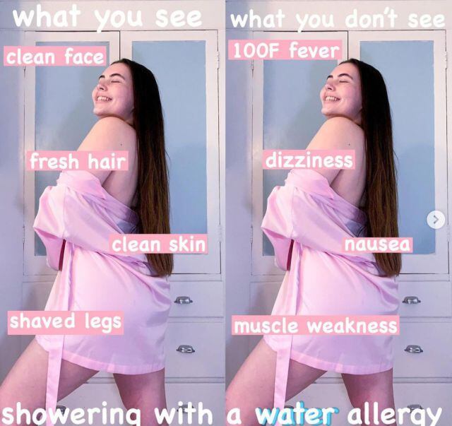 Tessa Hansen-Smith, joven de 22 años es alérgica al agua