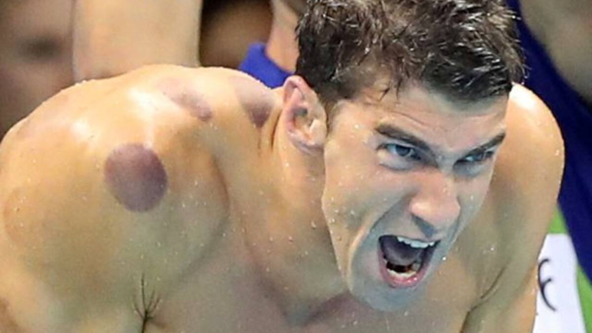 Esta es la razón de las tremendas manchas de Michael Phelps