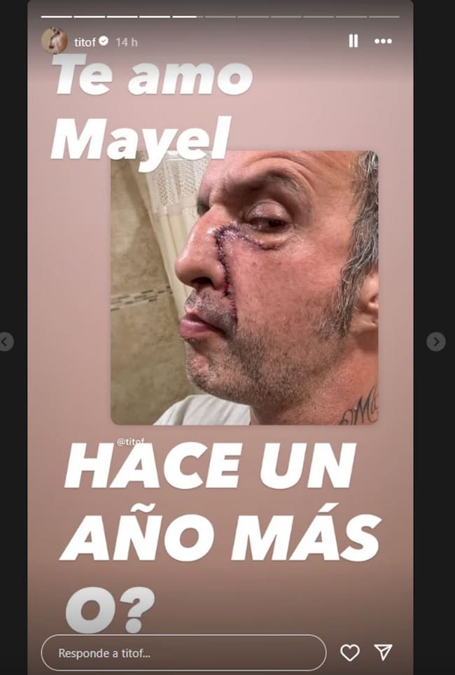 Tito fuentes cicatrices