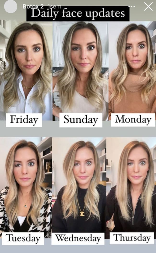 Whitney Boher: Mujer se aplica botox en la ceja y deforma su rostro