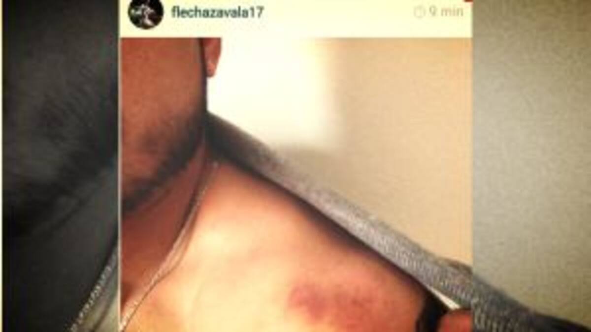 Zavala publica foto del mordisco de Juan Arango