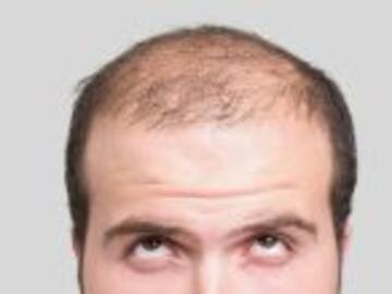 La posible cura de la calvicie