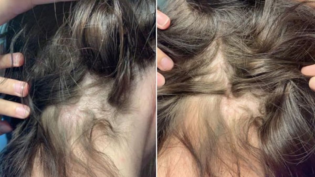 Mujer pierde cabello por usar acondicionador con crema depilatoria